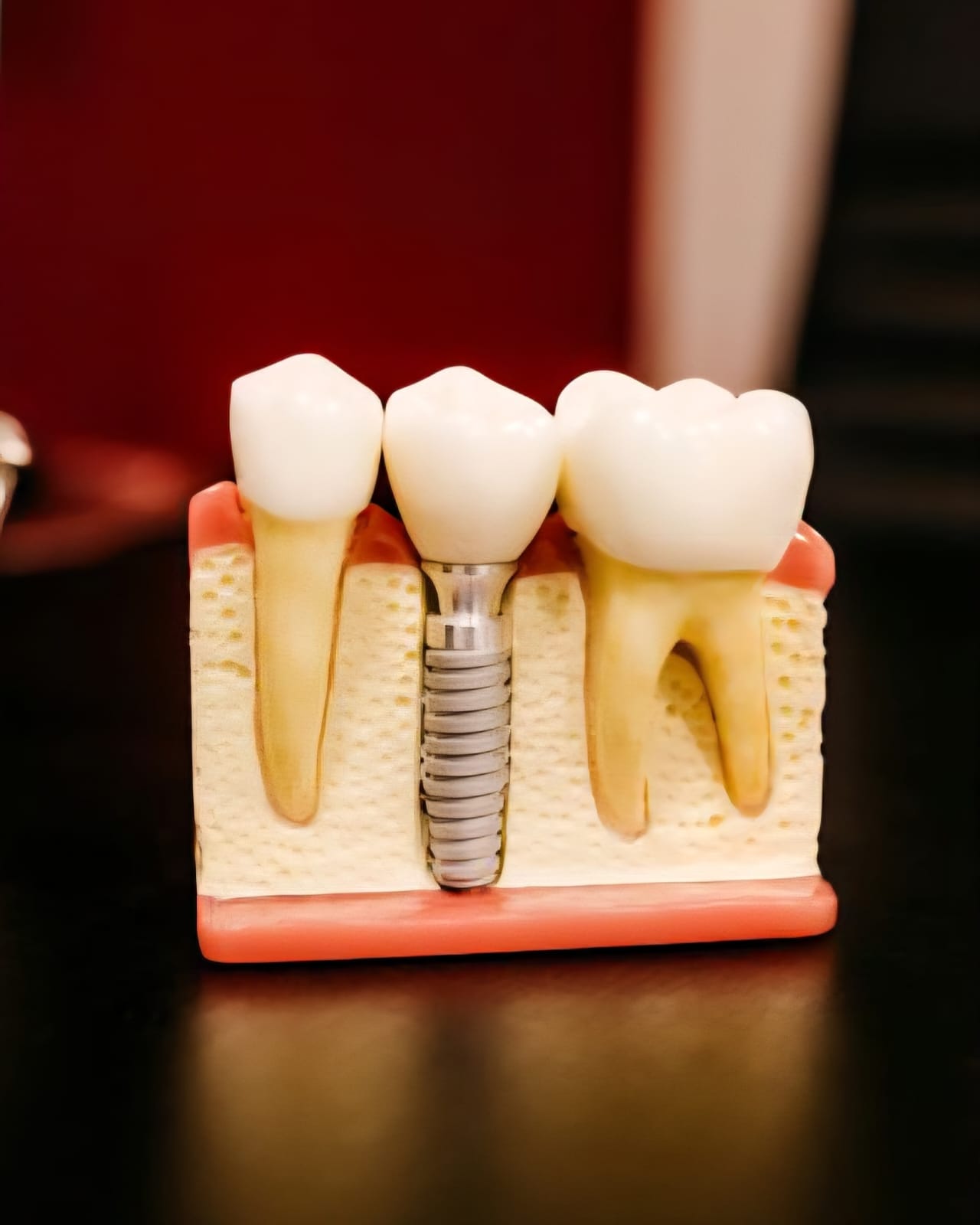 Dental Implants