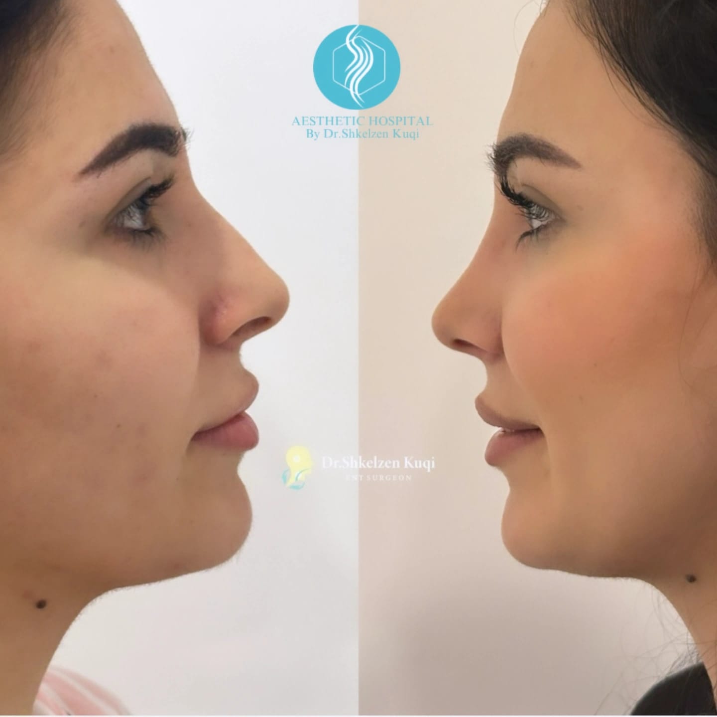 Septoplastic Surgery
