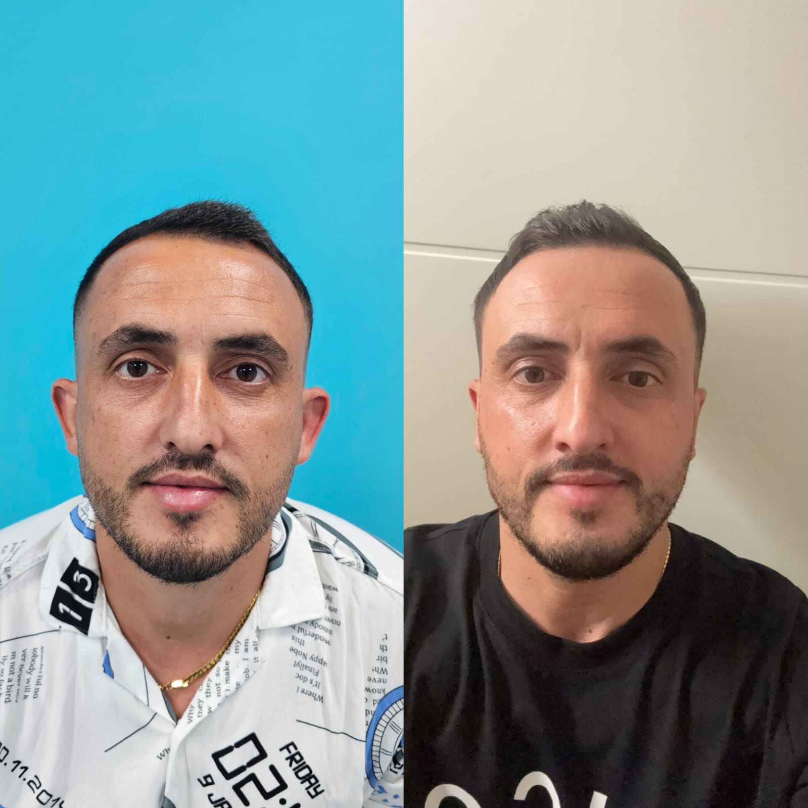 Otoplastic Surgery