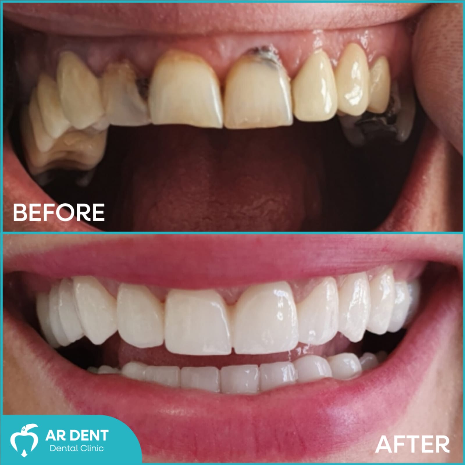 Dental Implants
