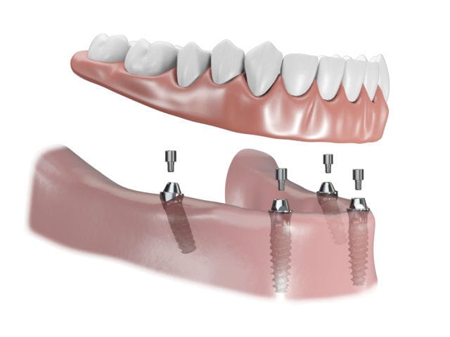 Multi-Unit Implants