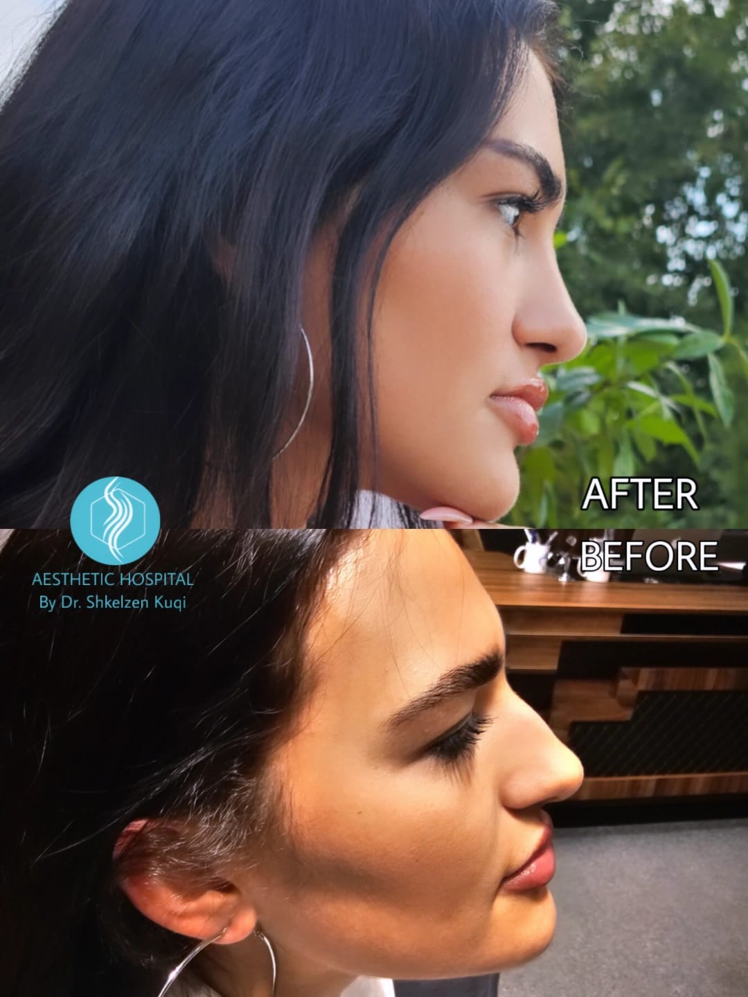 Rhinoplastic Surgery